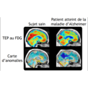 Le rôle de l\'Intelligence Artificielle dans la détection de la maladie d\'Alzheimer